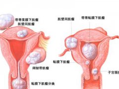 子宫肌瘤可分为什么种类