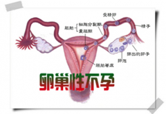 卵巢性不孕要做哪些检查？