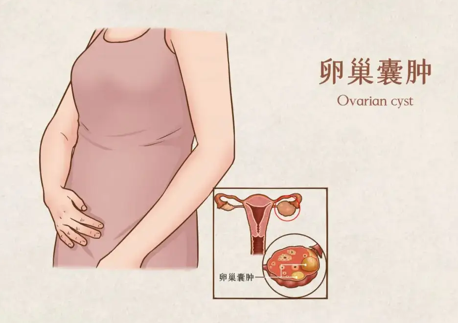 专家解析卵巢囊肿和性生活有关吗